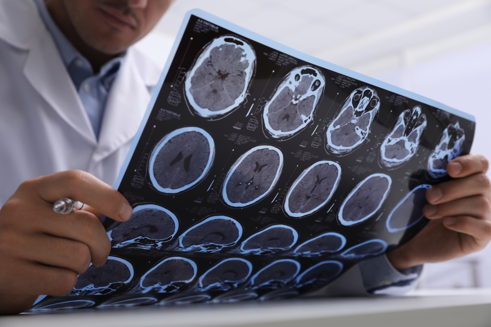 Doctor examining a brain MRI scan film
